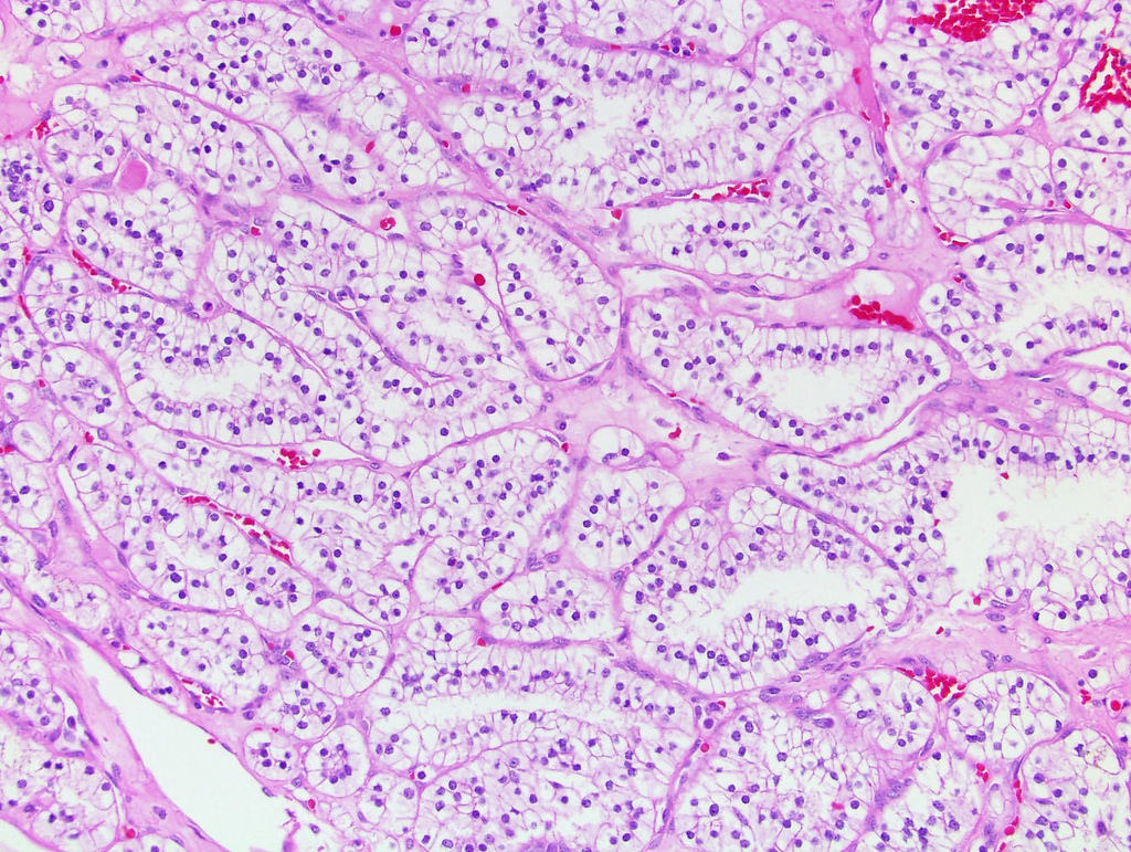 Pictures gallery of Gallery cell papillary clear kidney pathology rcc outli...