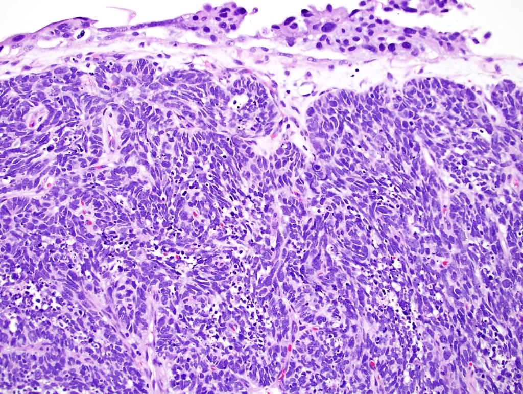 Pathology Outlines Small Cell Neuroendocrine Carcinoma