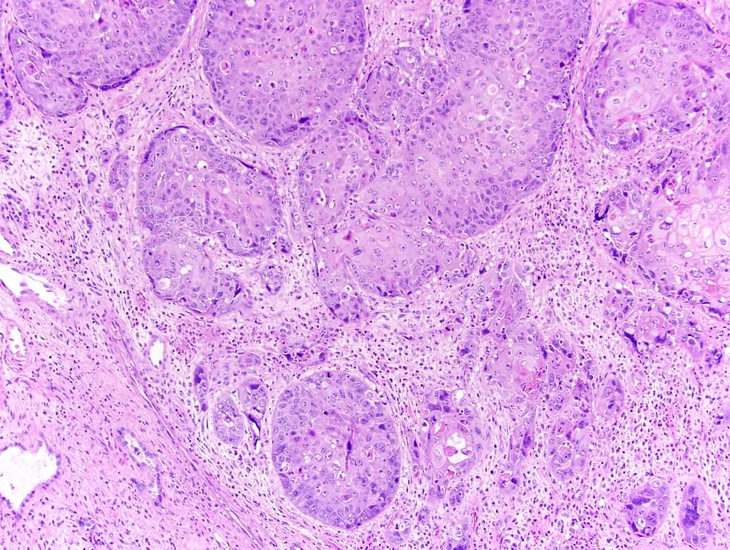 No urothelial differentiation