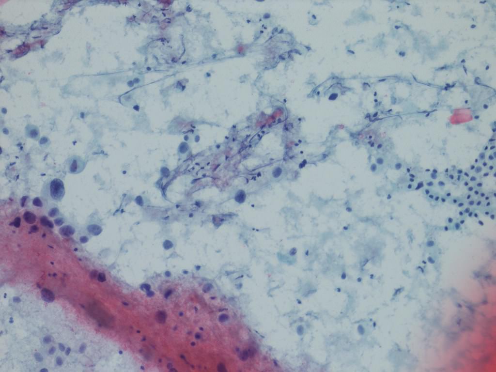 Highly atypical cells
