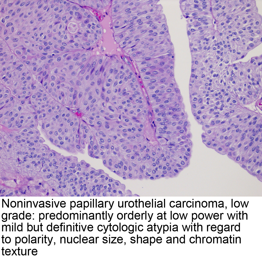 papillary urothelial neoplasm pathology outlines