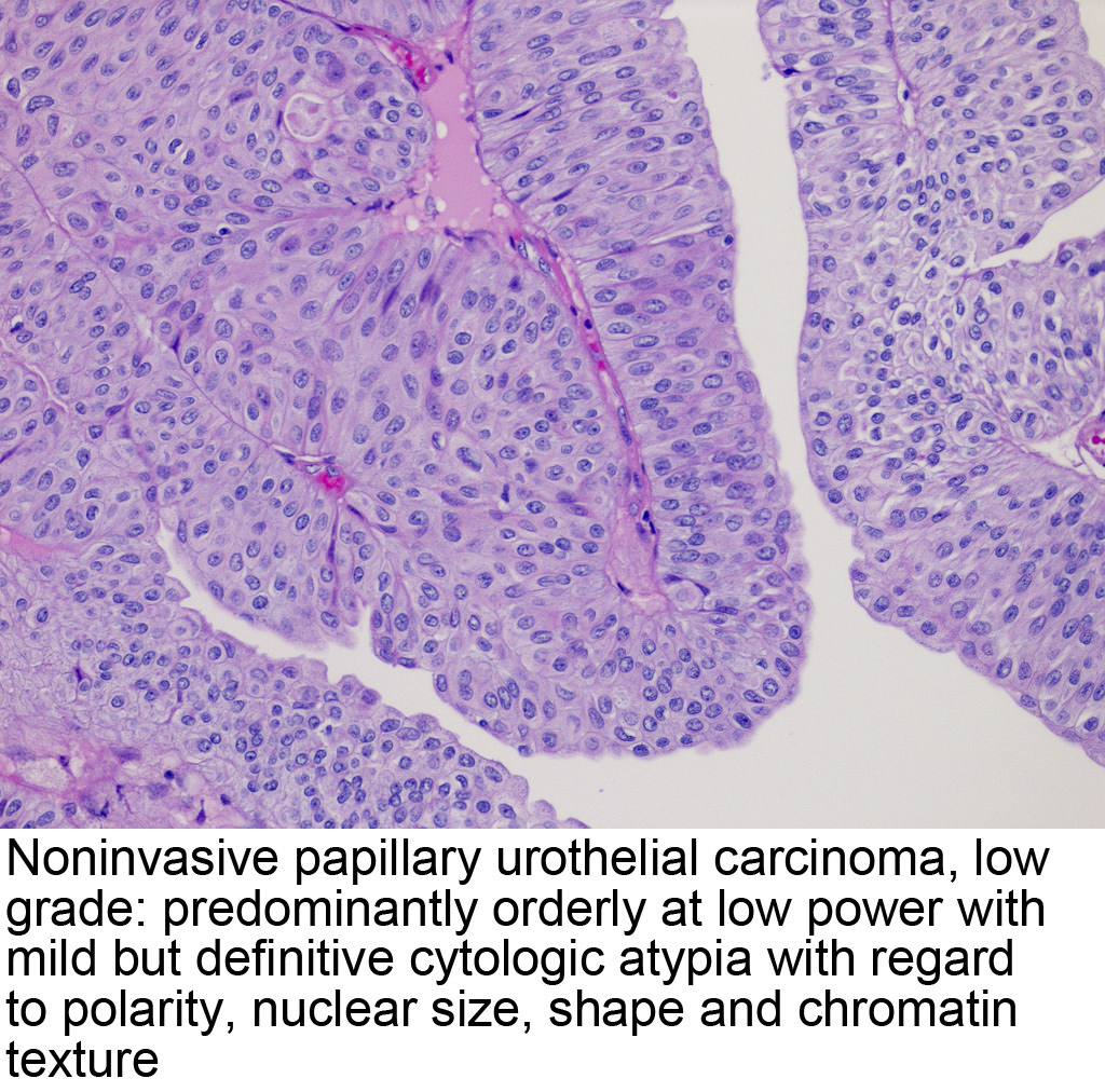 what does papillary urothelial mean