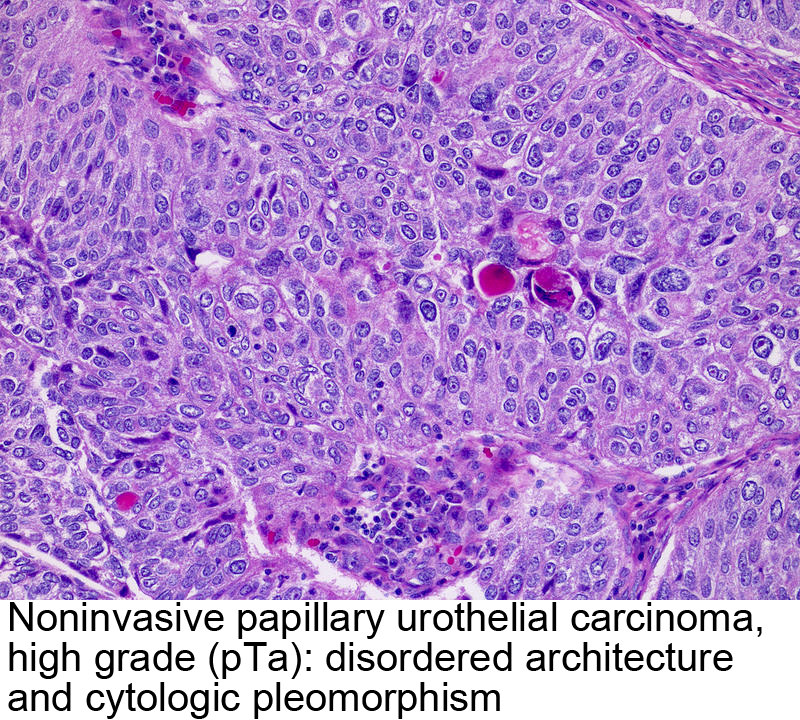 papillary urothelial neoplasm pathology outlines)