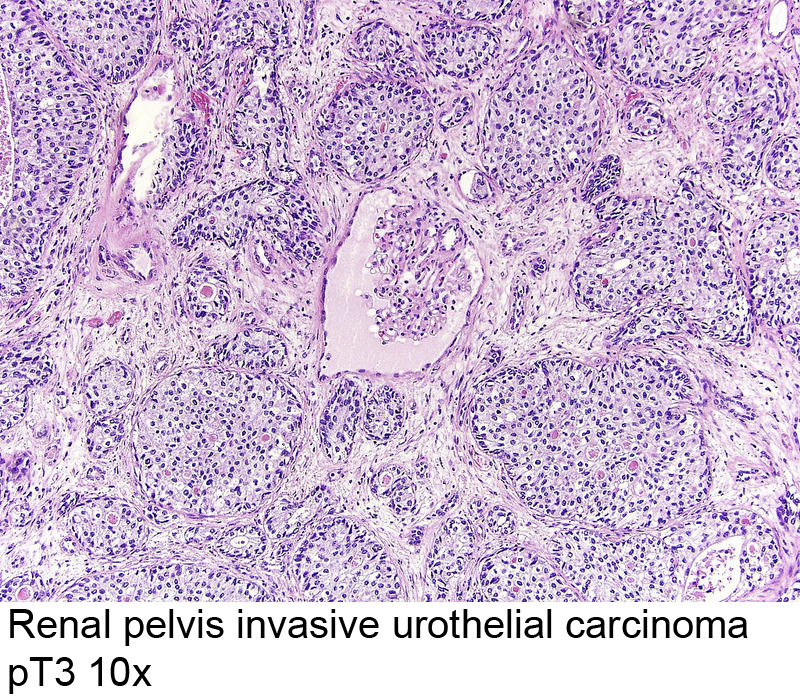 urothelial carcinoma prostate pathology outlines)