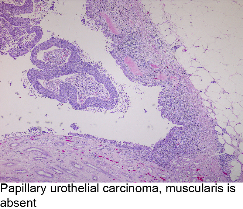 Papillary urothelial pathology outlines