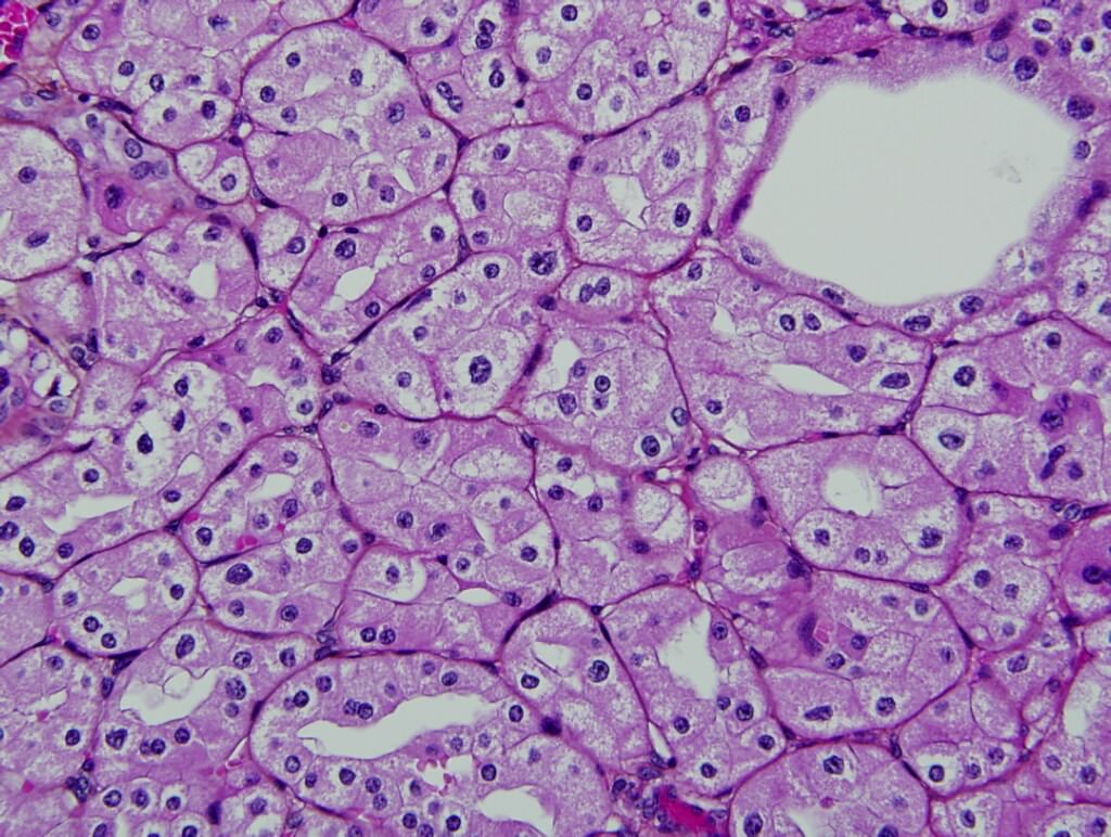 Oncocytic tumor cells