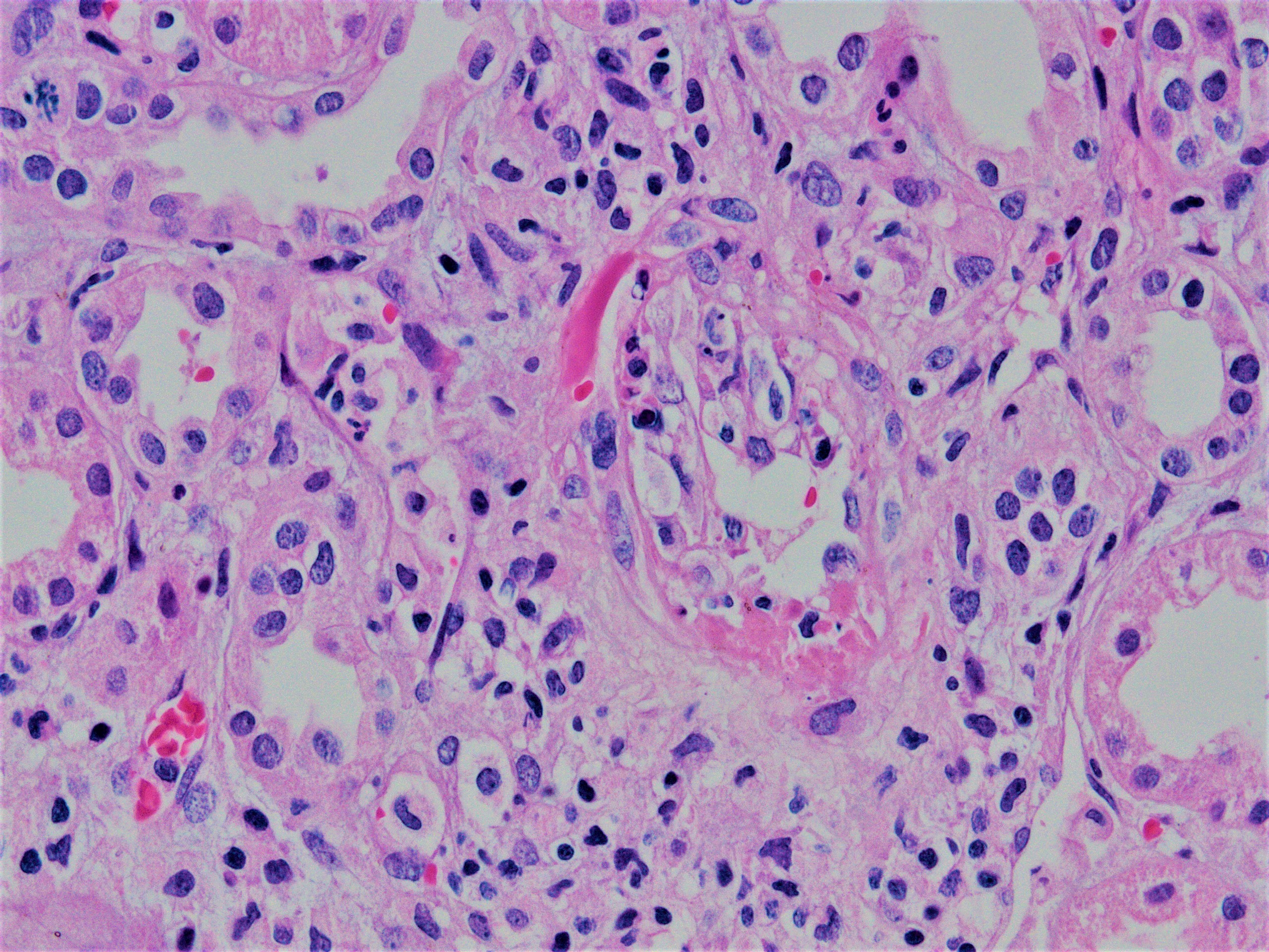 Transmural arteritis and fibrinoid necrosis