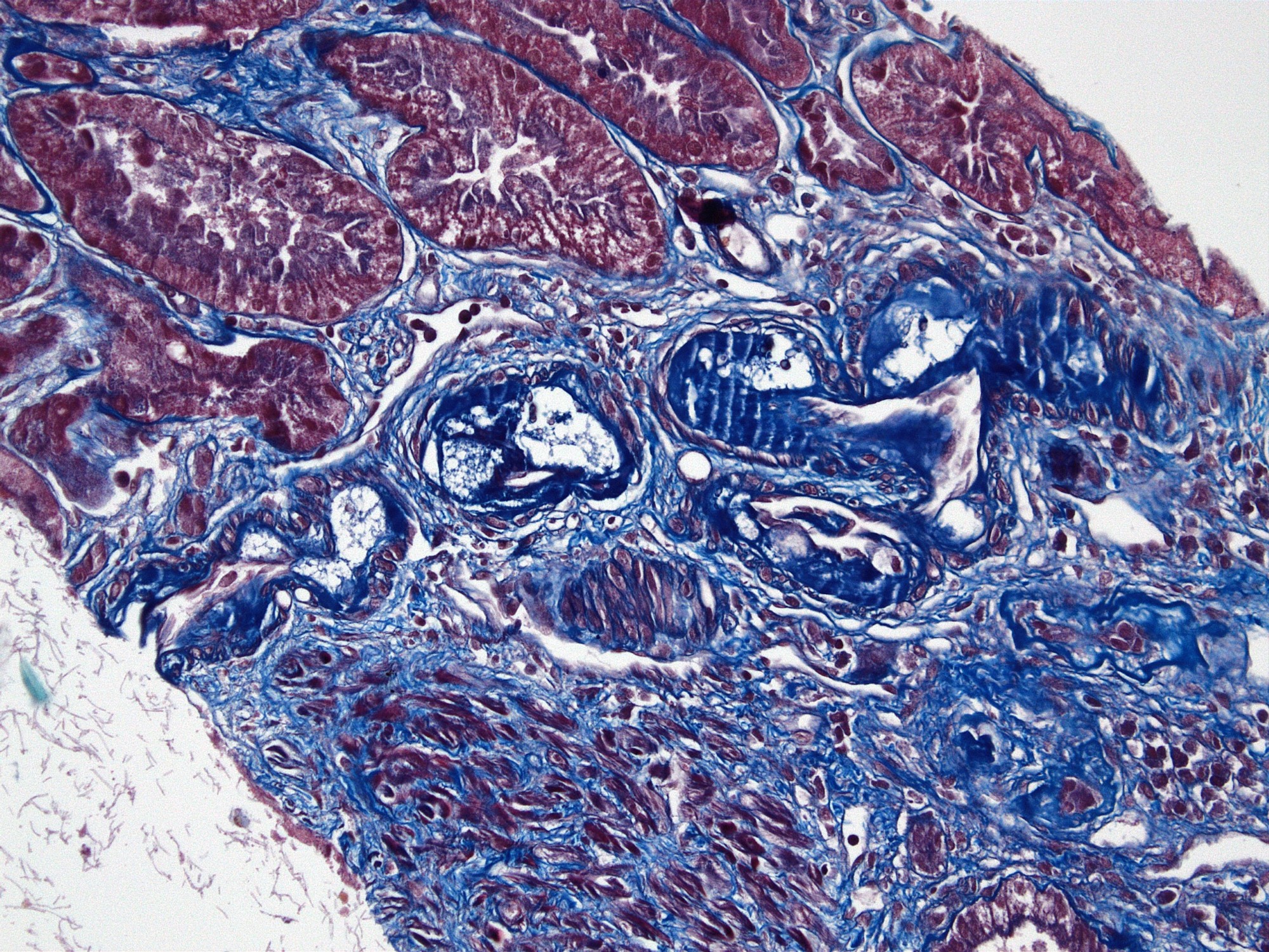 Intimal foam cells and fibrosis in small artery, MTC