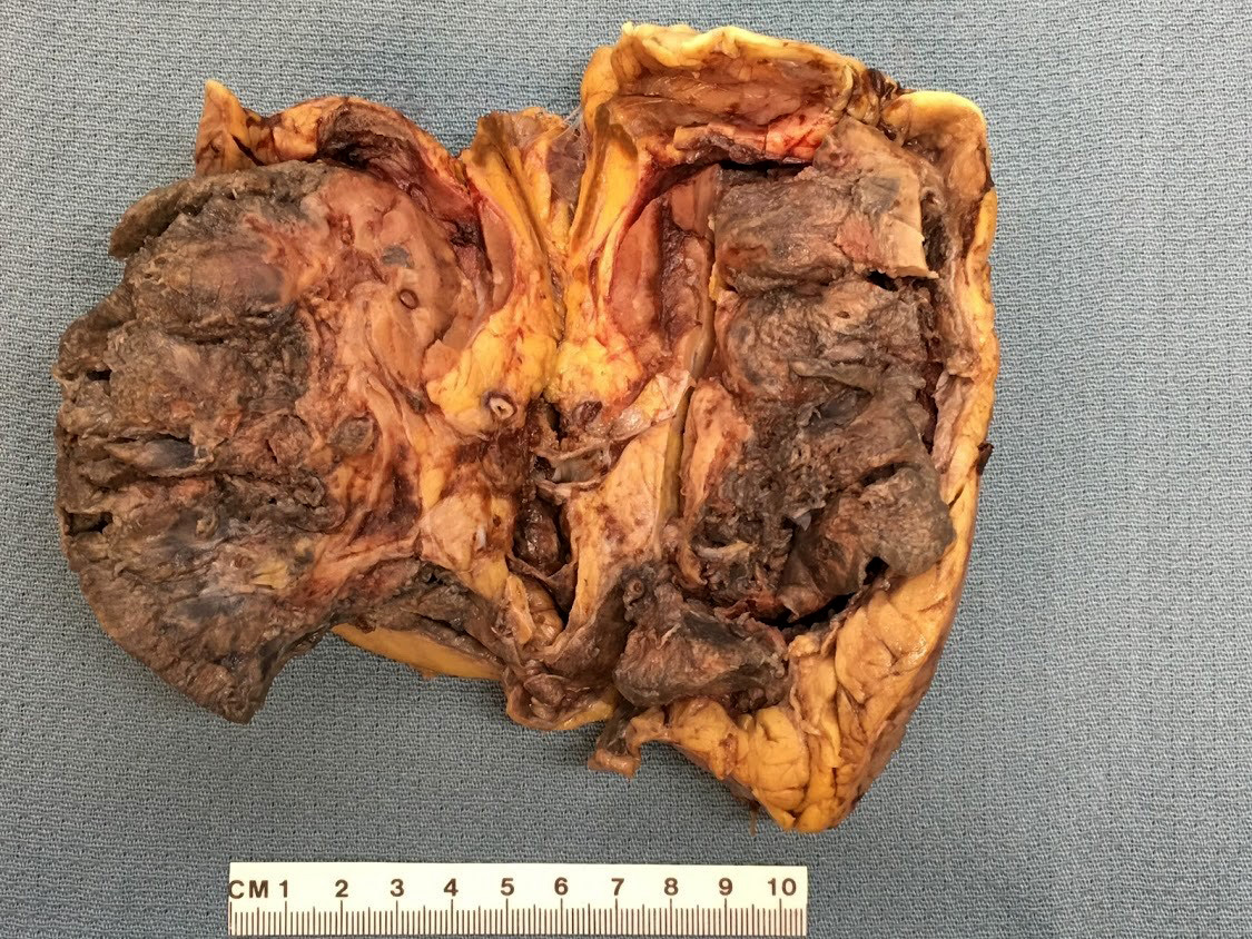Bisected kidney