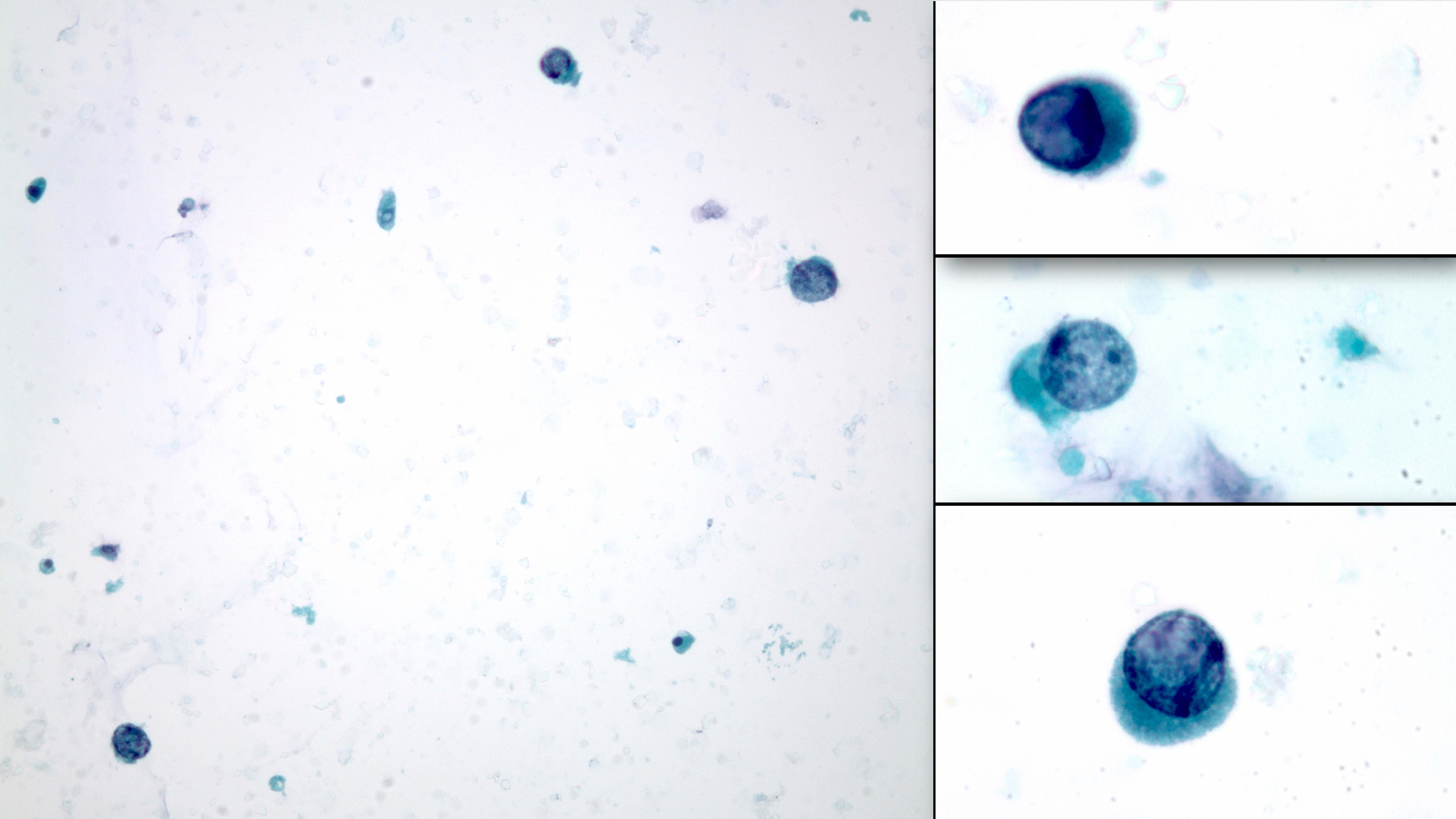 Decoy cells in urine cytology