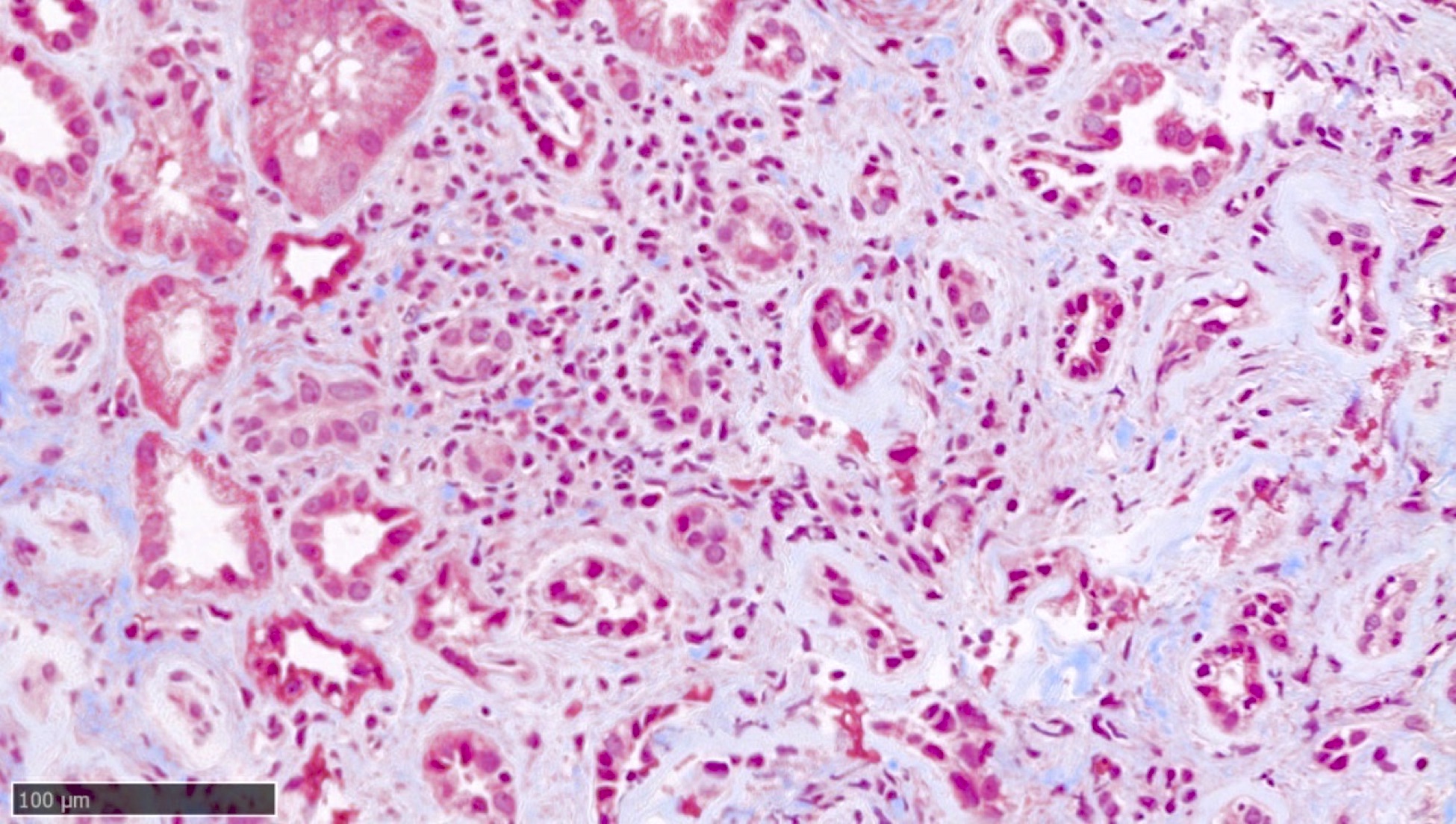 Renal cortical parenchyma with tubular atrophy and interstitial fibrosis, Masson Trichrome special stain 