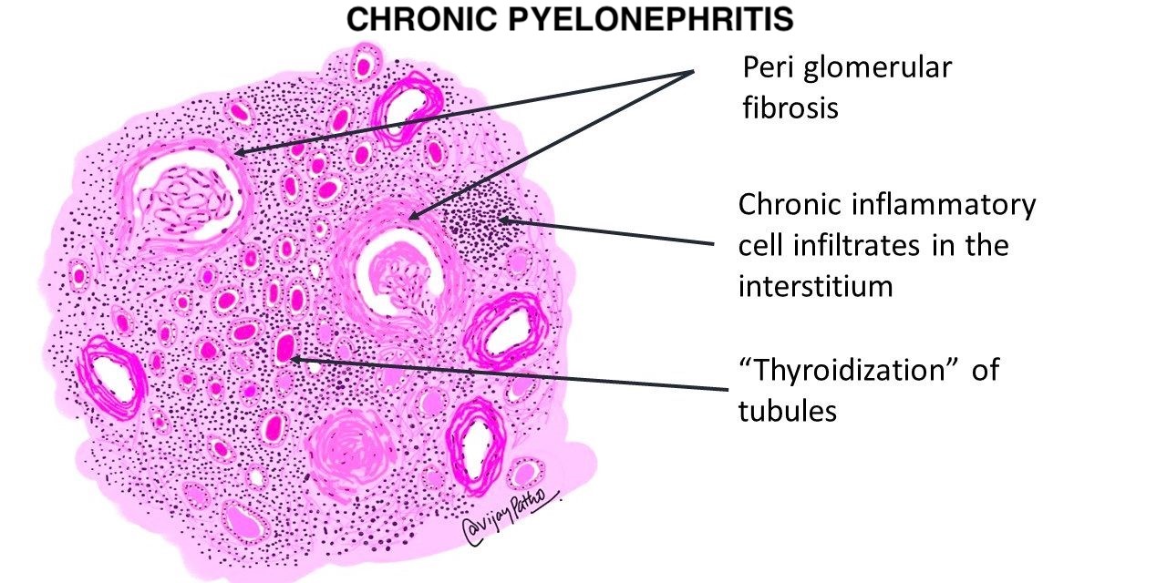 Schematic of Chronic Pyelonephritis