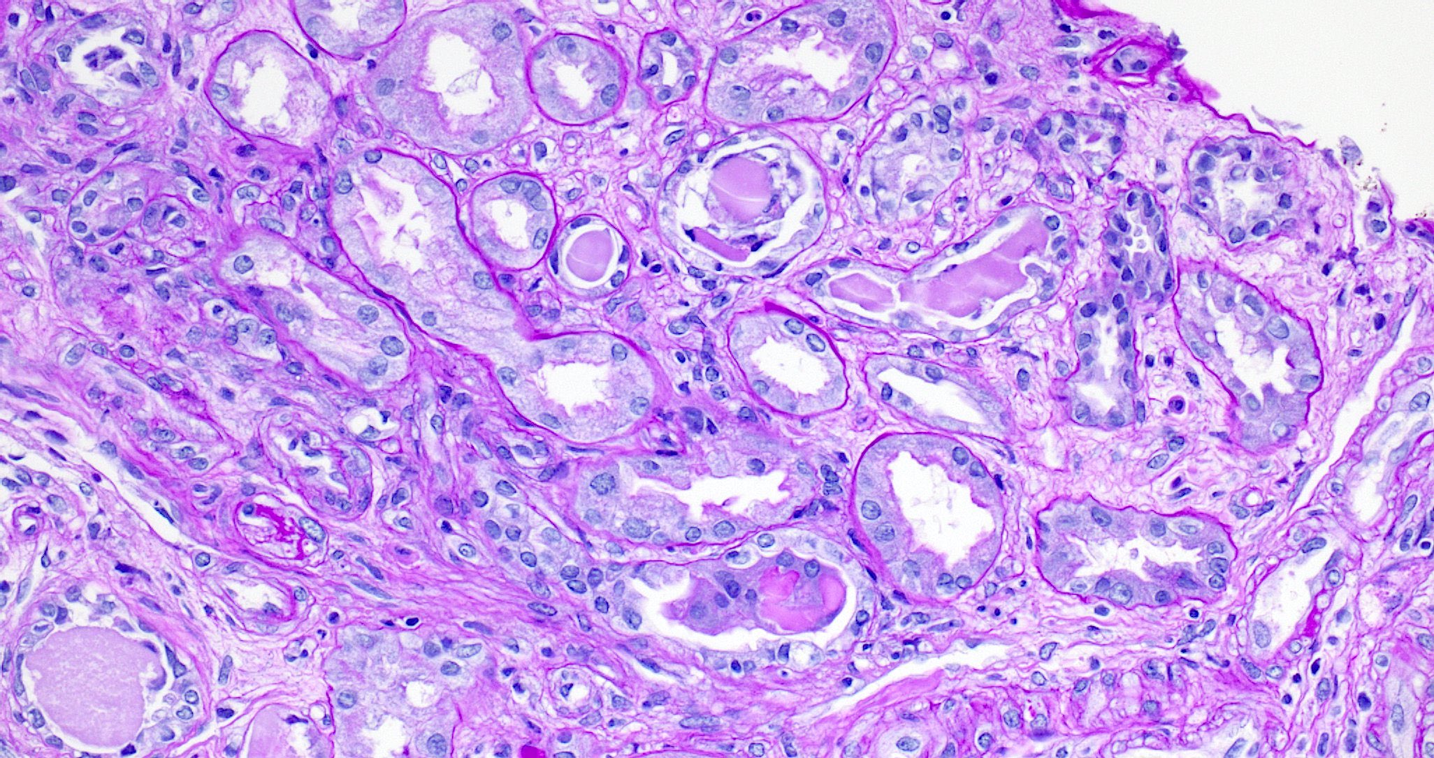 Pale casts with giant cell reaction