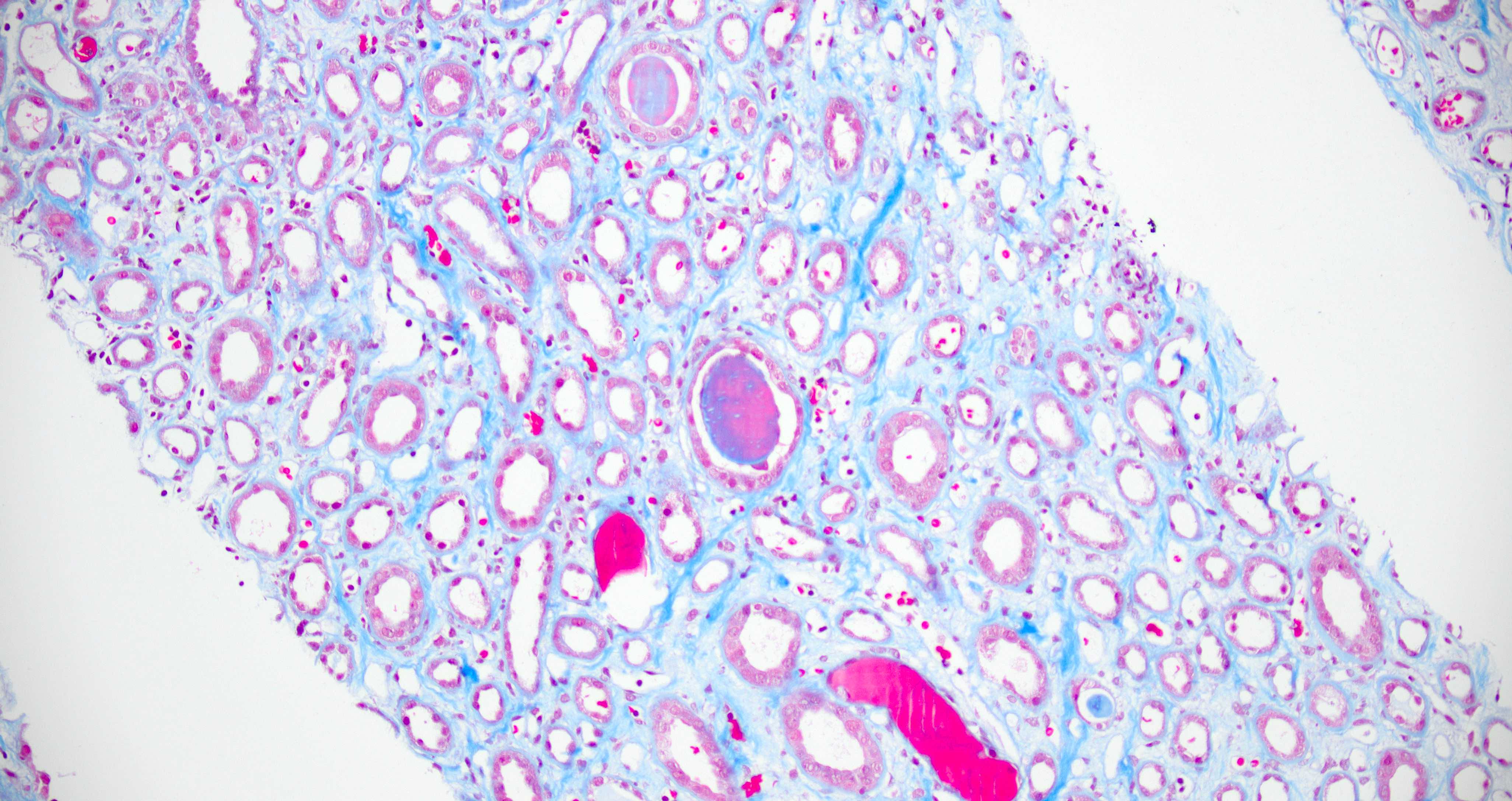 Metachromatic casts, trichrome stain