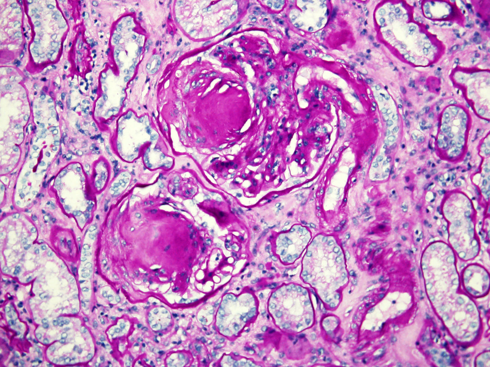 Kimmelstiel-Wilson nodules, hyaline arteriolosclerosis