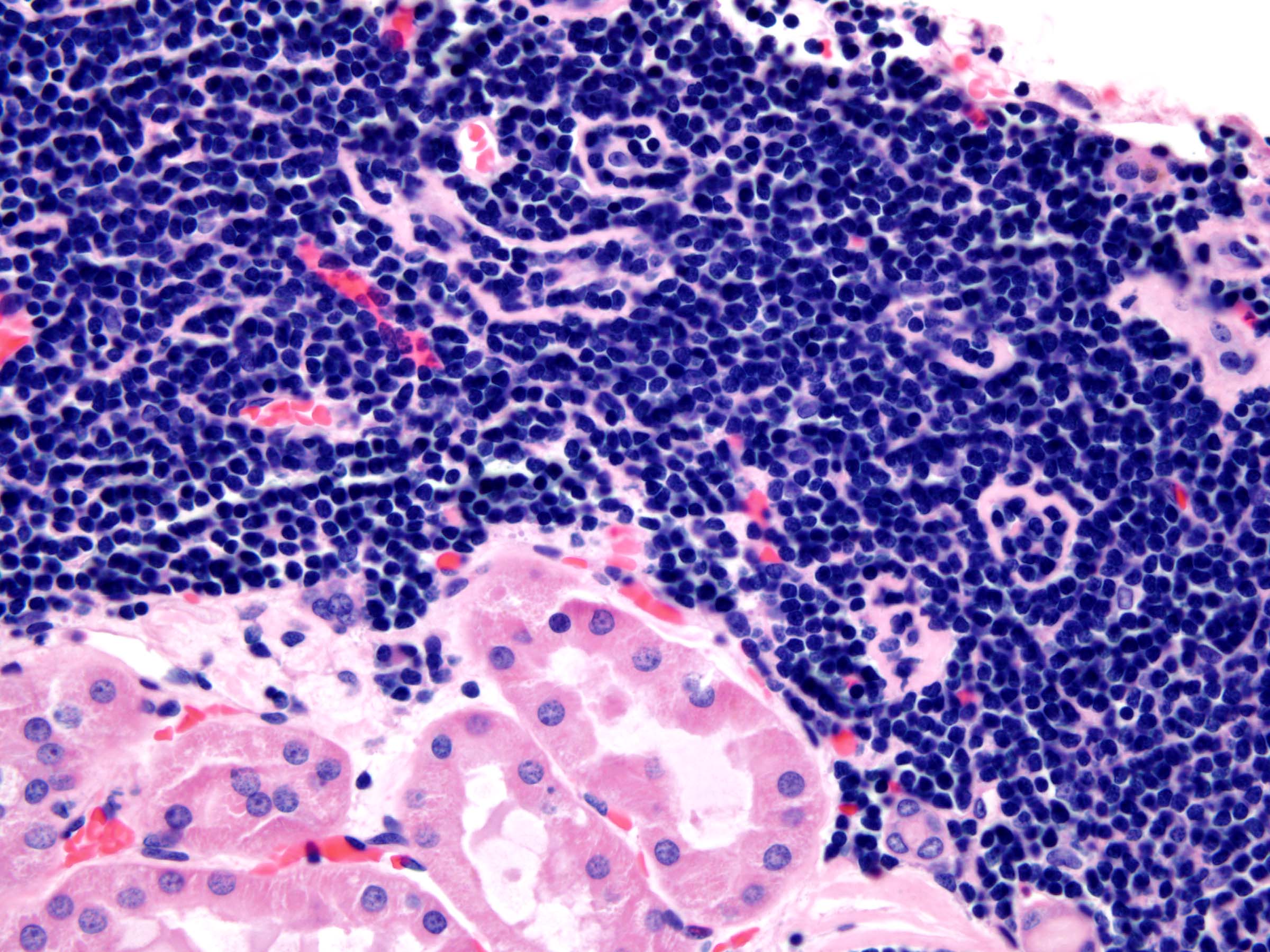 Monotonous dense small lymphocytes