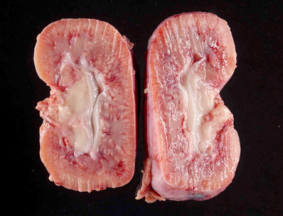 Enlarged pale kidney