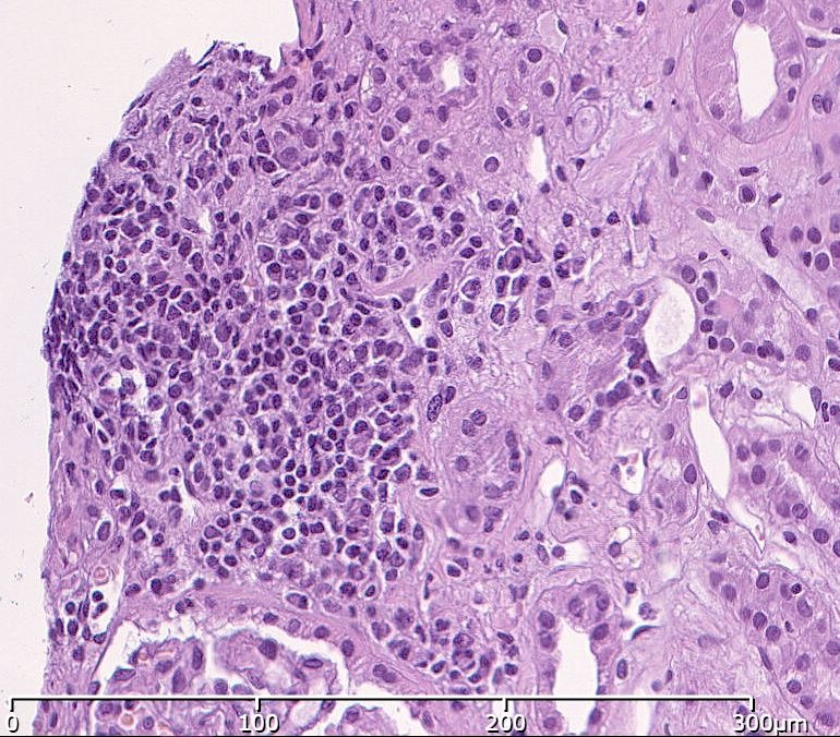 Plasma cell rich infiltrate