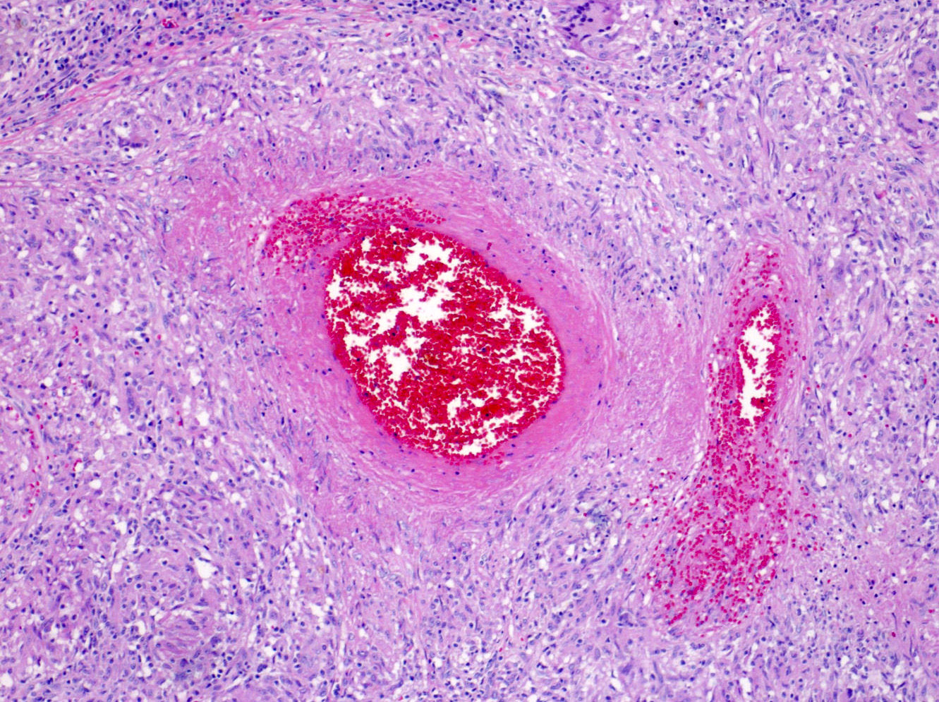 Active vasculitis with giant cells