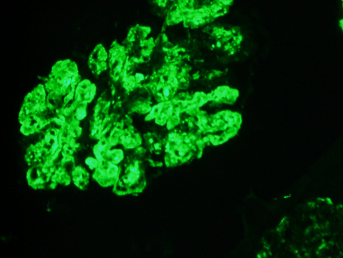 C3 staining in C3 glomerulopathy (C3 GN variant)