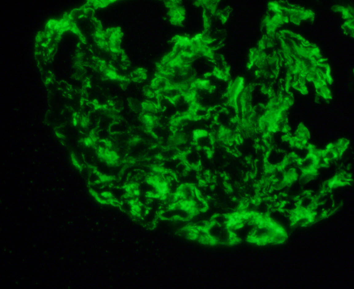Restricted kappa positive staining of glomerulus in PGNMID
