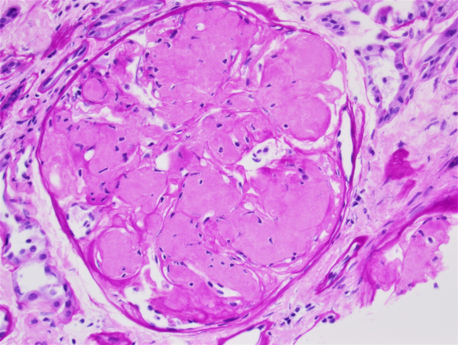 Nodular expansion of mesangium of glomerulus, AL amyloid