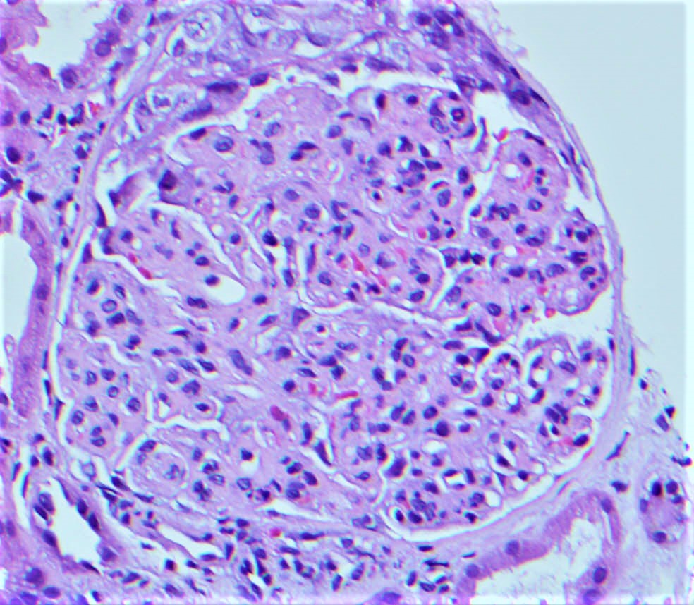 Membranoproliferative pattern of glomerulus  in PGNMID