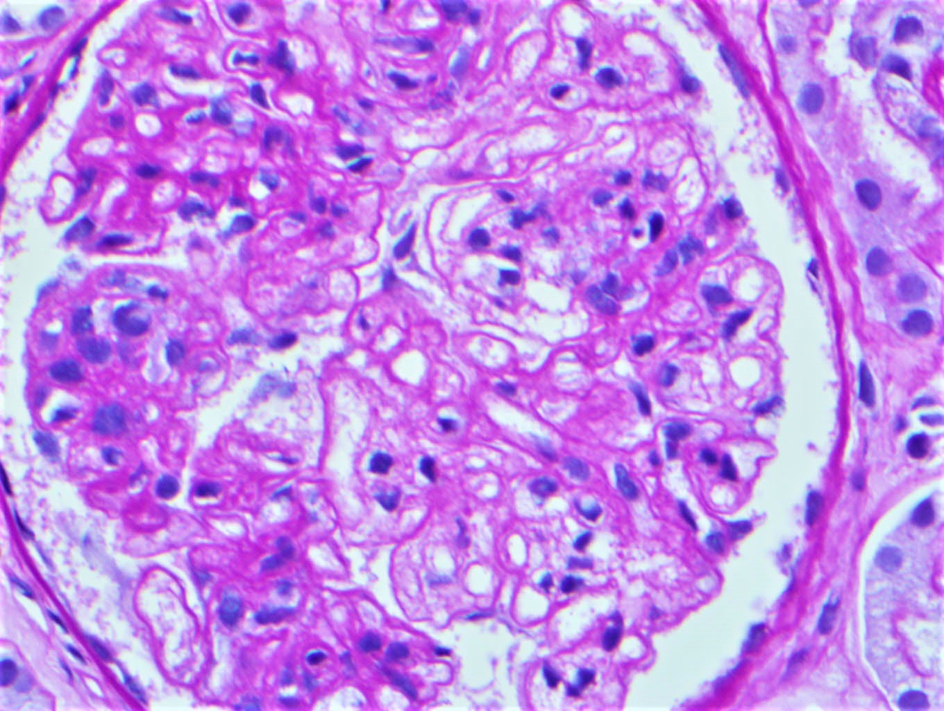 Mesangiolysis in a case of TMA with monoclonal gammopathy