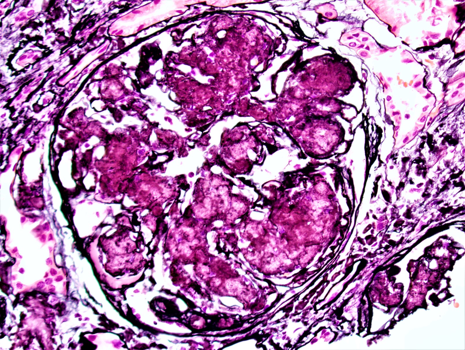 Nodular expansion of mesangium of glomerulus, AL amyloid