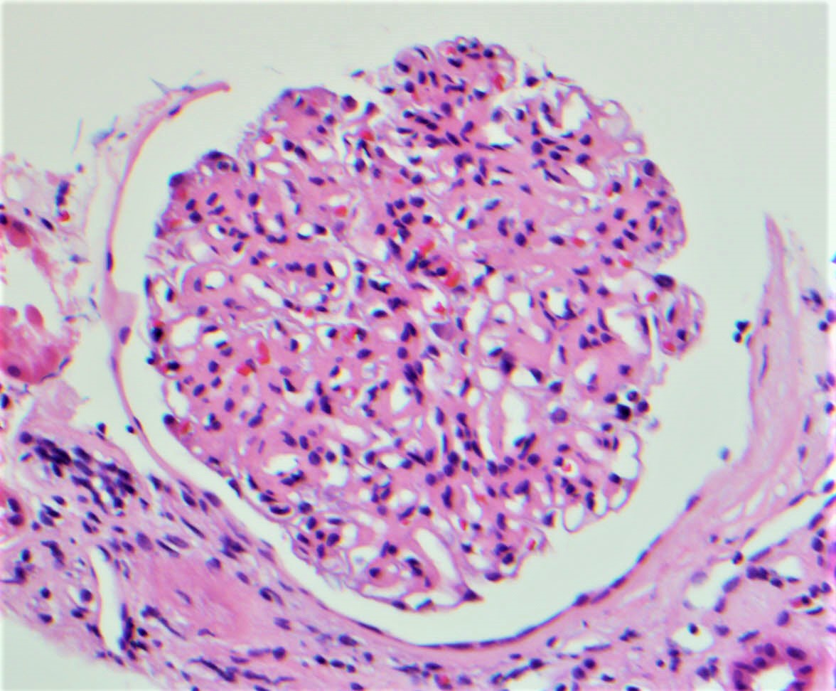 Mesangial matrix expansion (nonnodular) of glomerulus, FGN