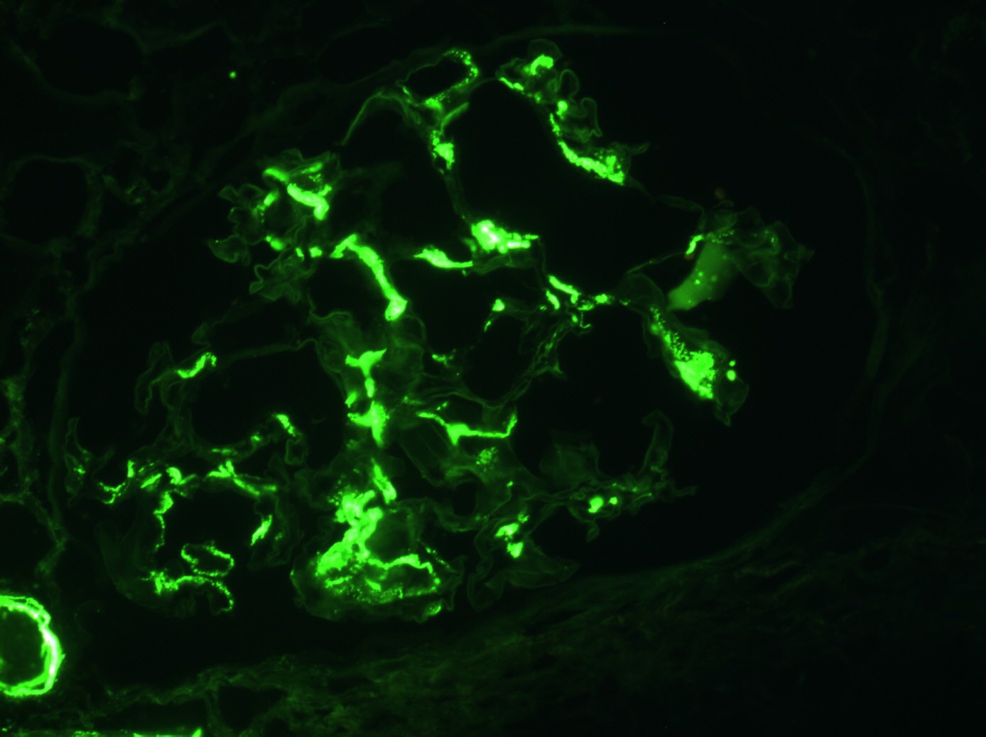 Mesangial IgA deposition, immunofluorescence