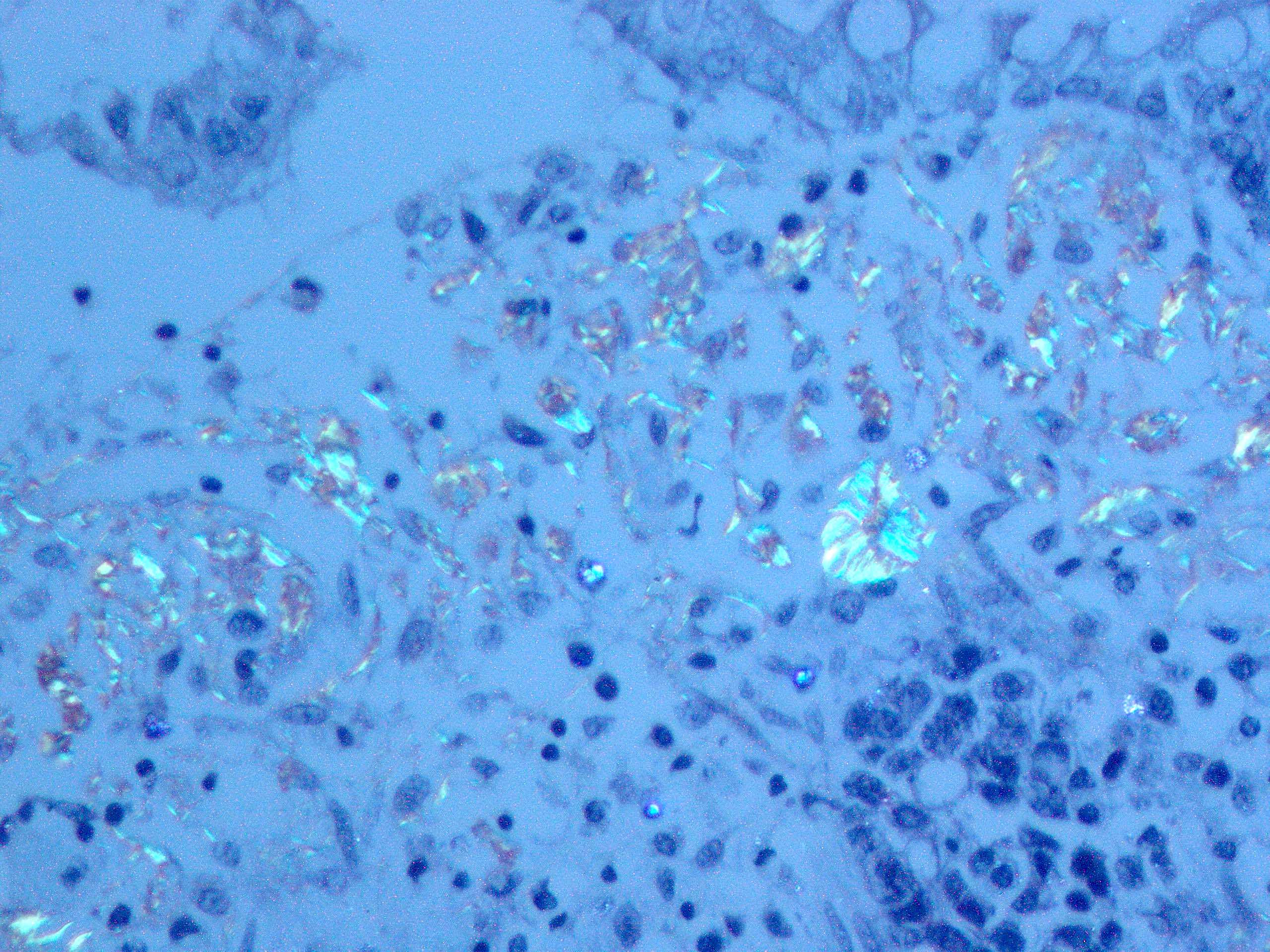Recurrent amyloidosis in allograft, Congo stain polarized microscopy