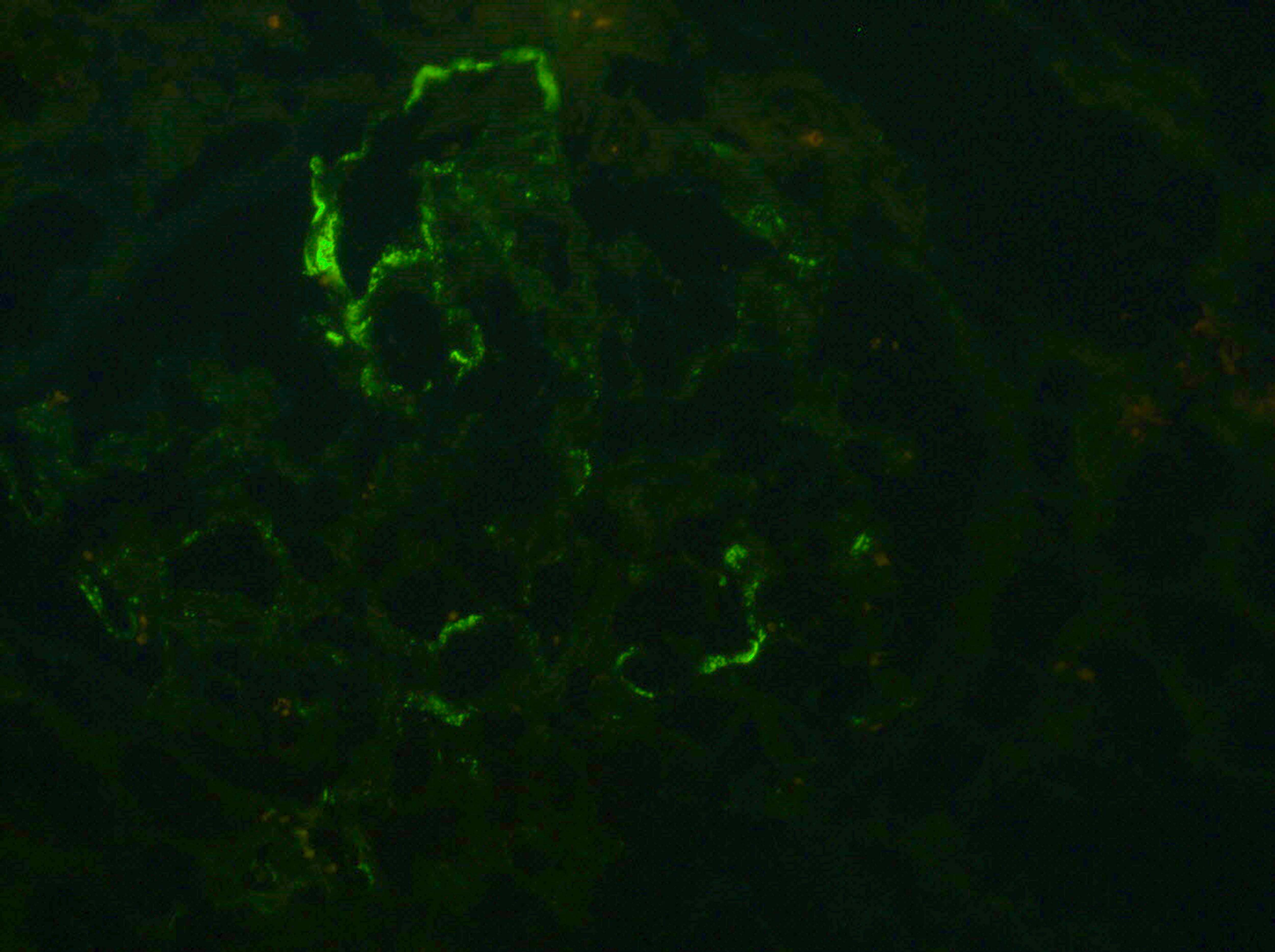 Nonspecific IgM deposition, immunofluorescence