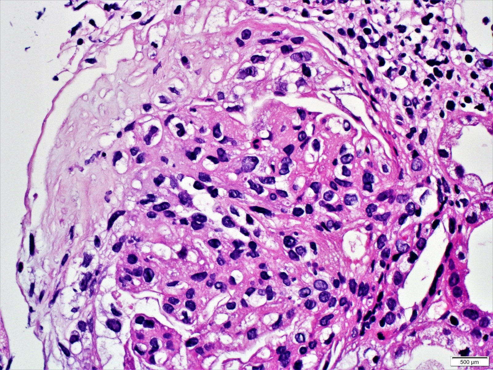 Fibrocellular fibrous crescent