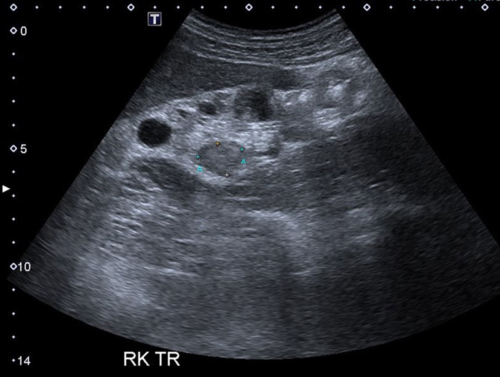 Isoechoic mass under ultrasound