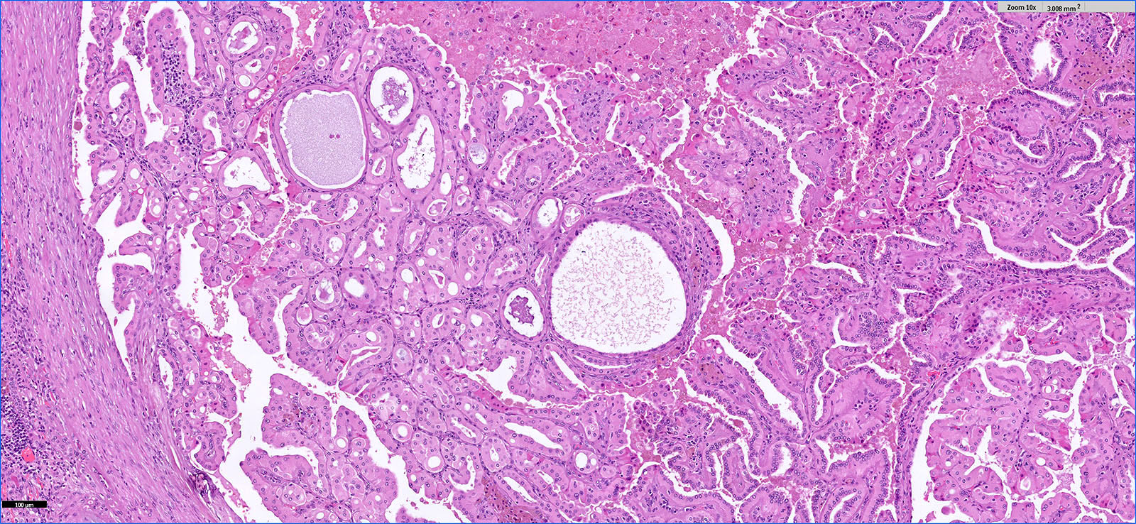 Tubulopapillary pattern