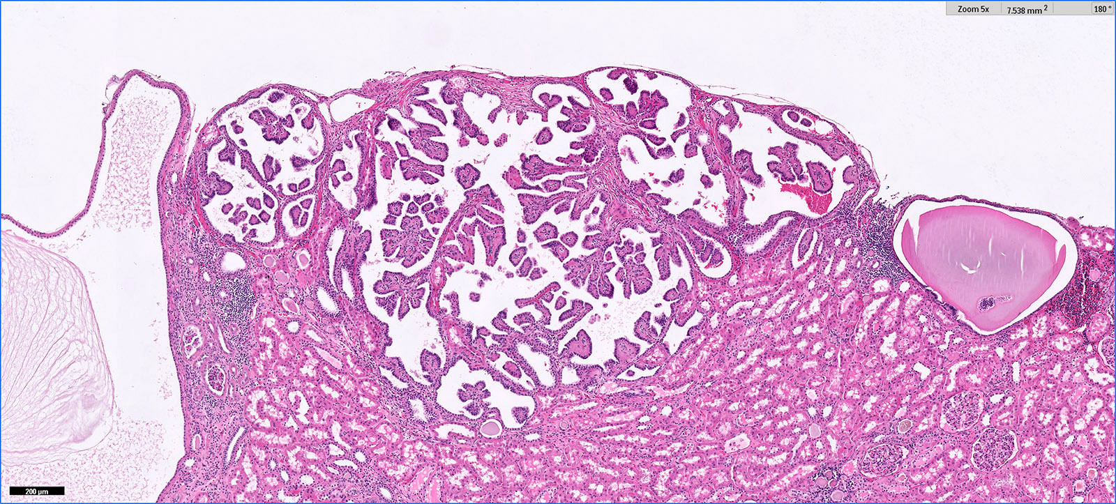 Type D papillary adenoma