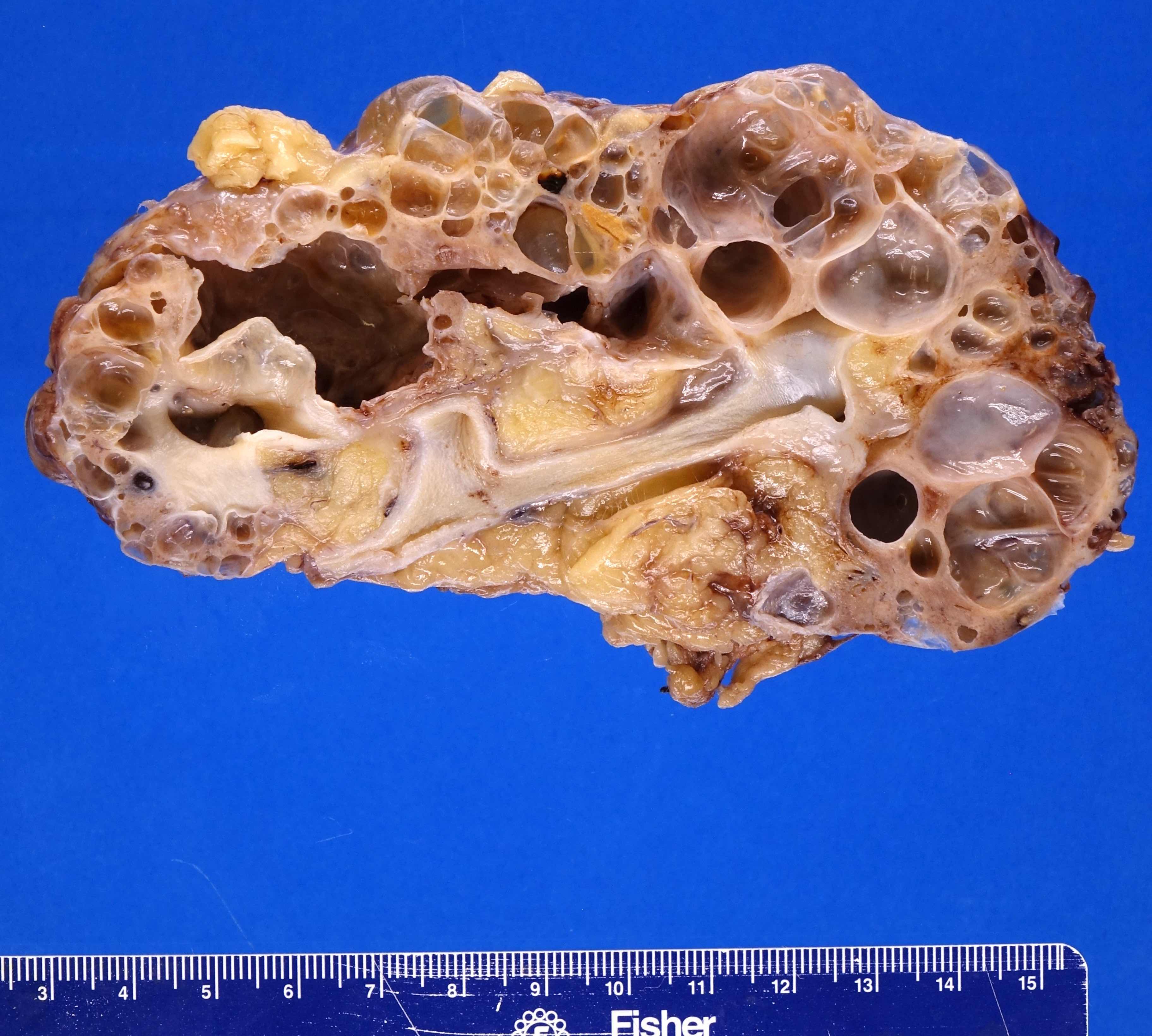 Numerous cysts of varying sizes