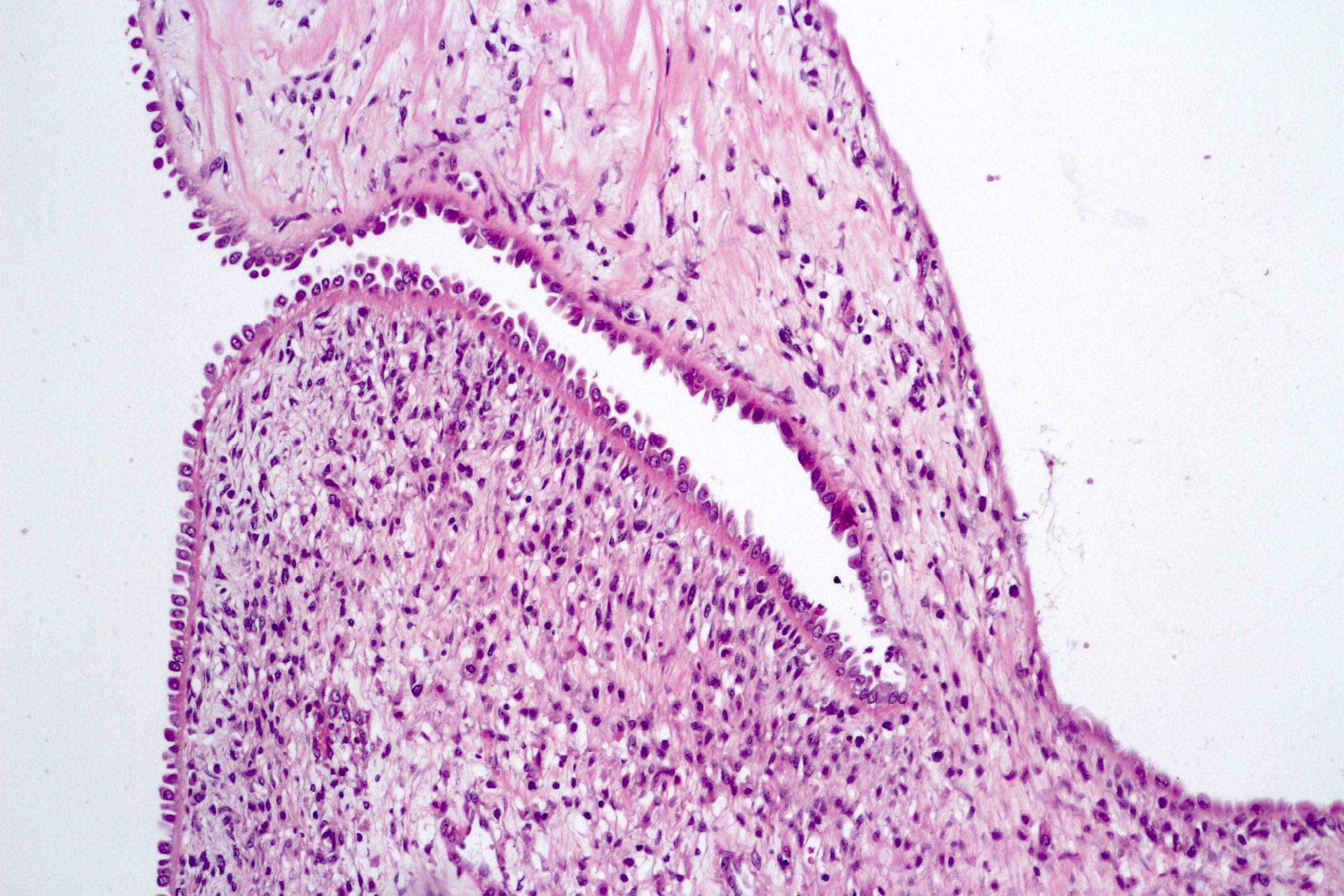 Fibrous septa and epithelial lining