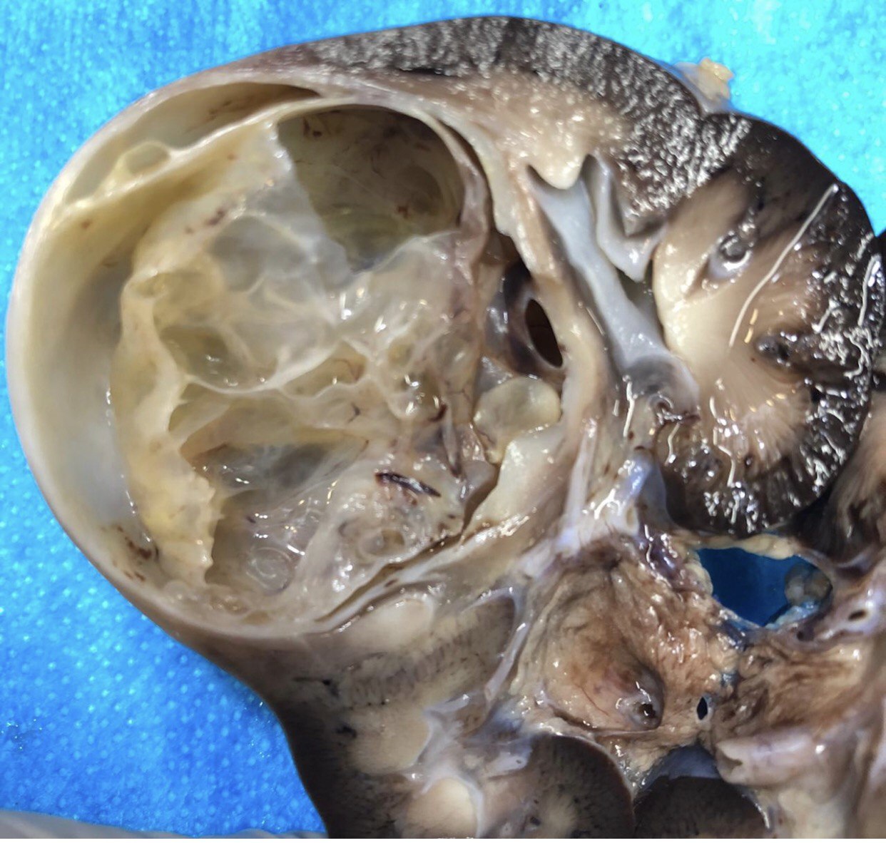 Multilocular cyst of the kidney