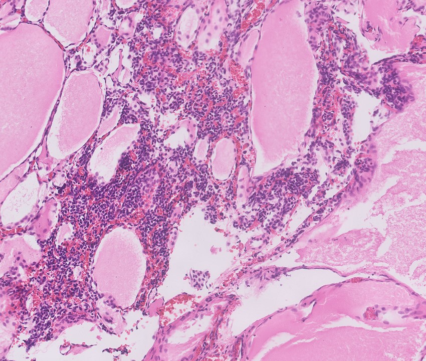 Cystic partially differentiated nephroblastoma