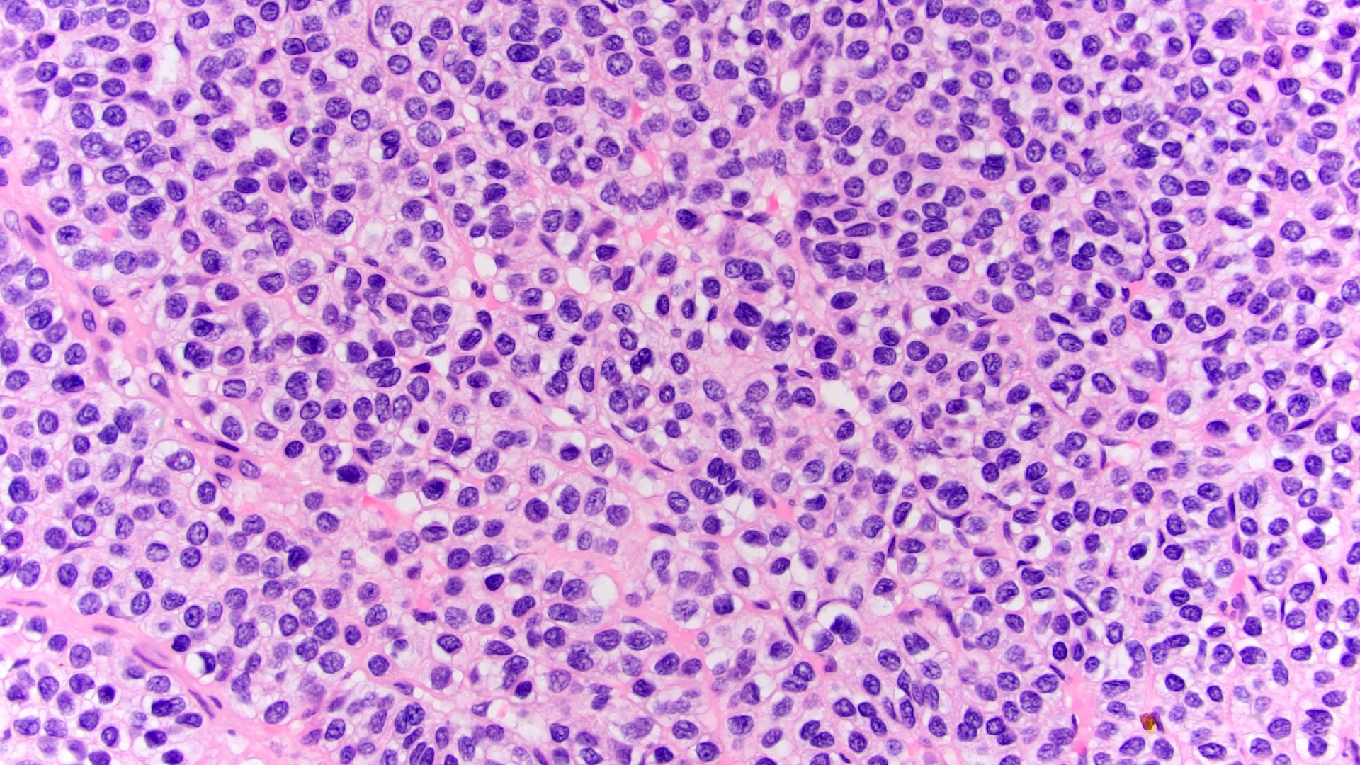 Small uniform tumor cells