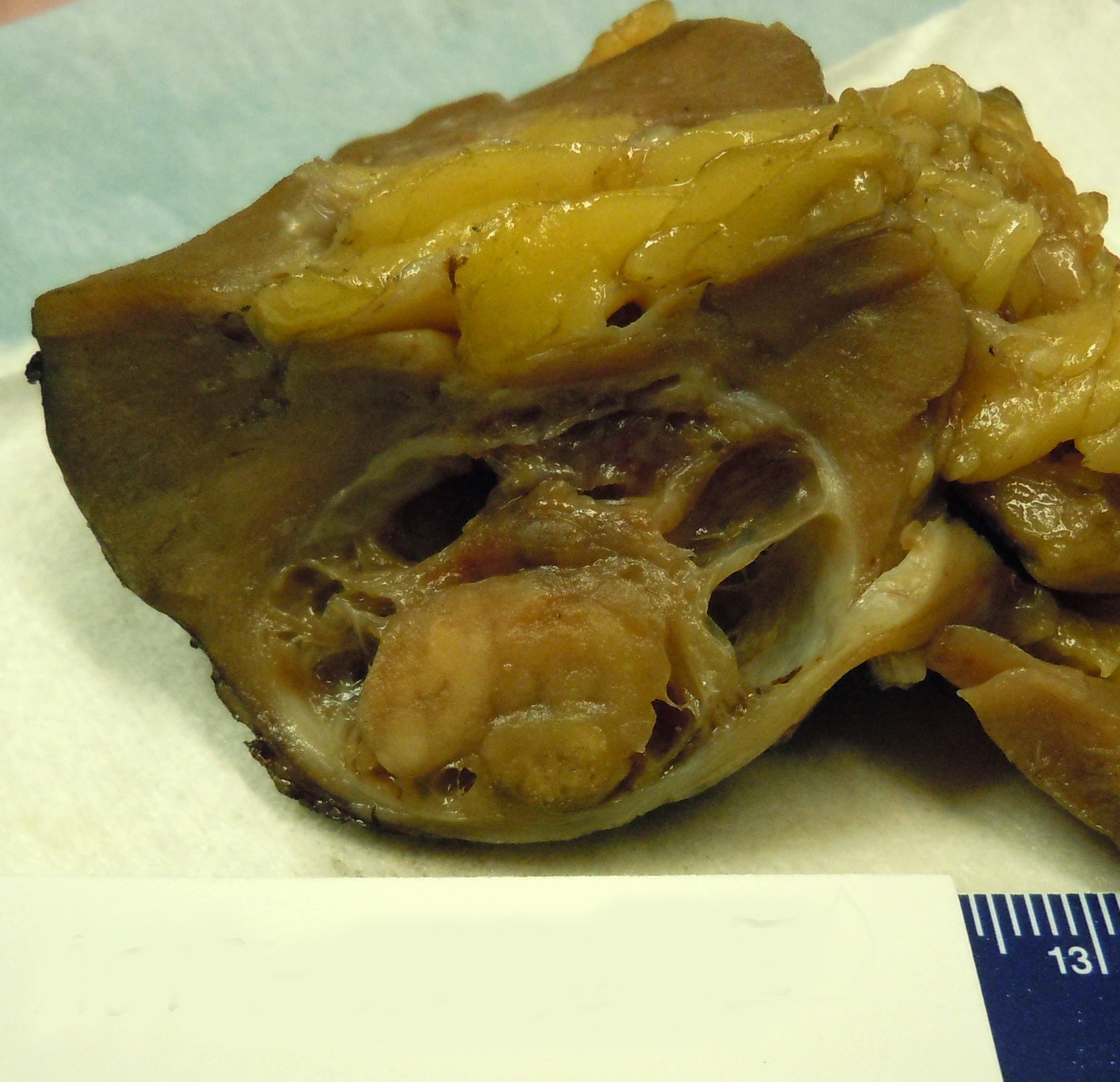Partial nephrectomy specimen