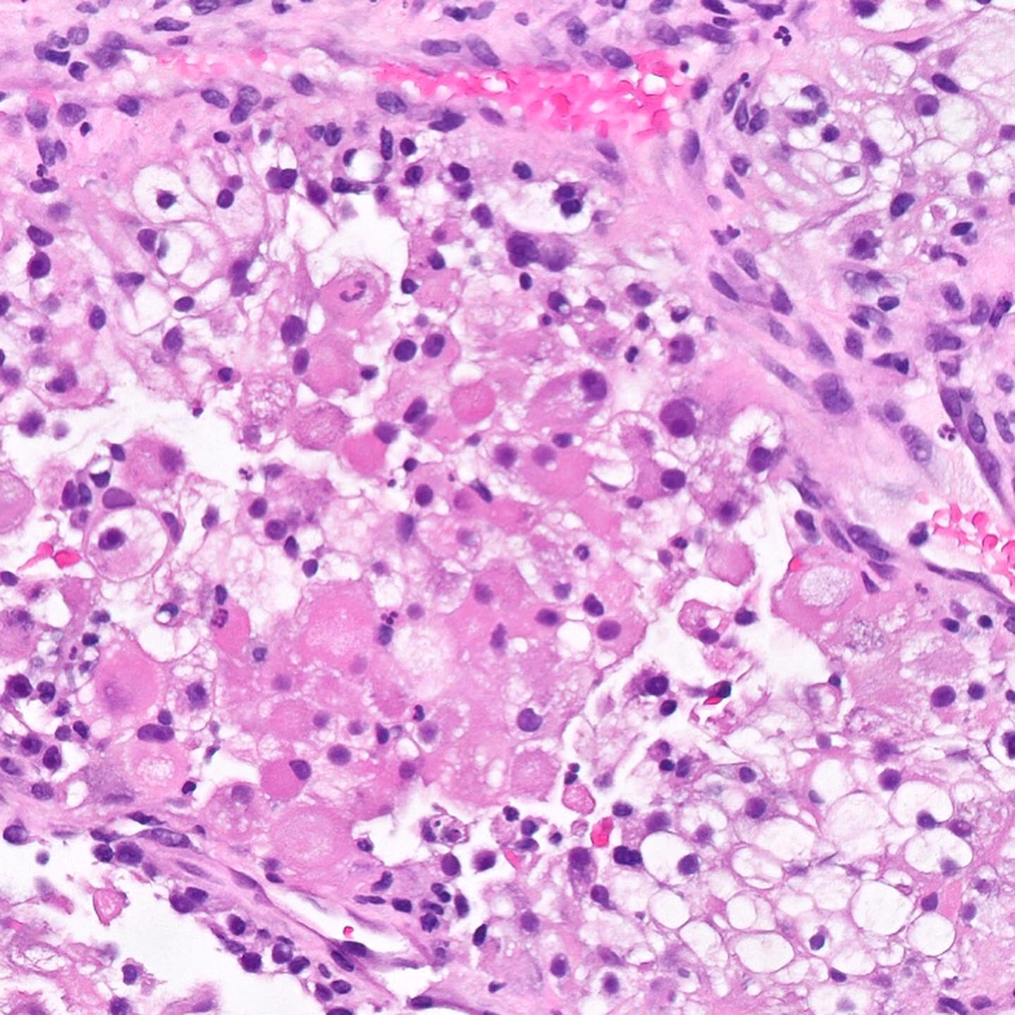 Adult renal cell carcinoma - rhabdoid variant
