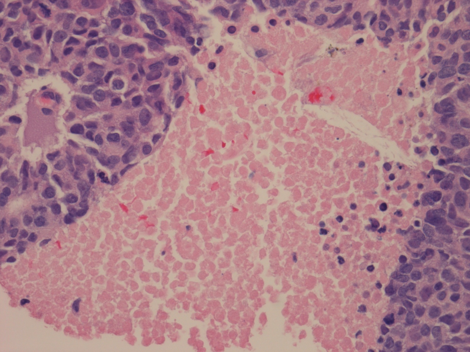 neuroendocrine carcinoma prostate pathology outlines
