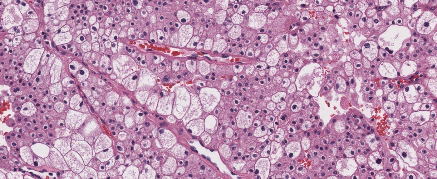 Large polygonal and smaller eosinophilic cells