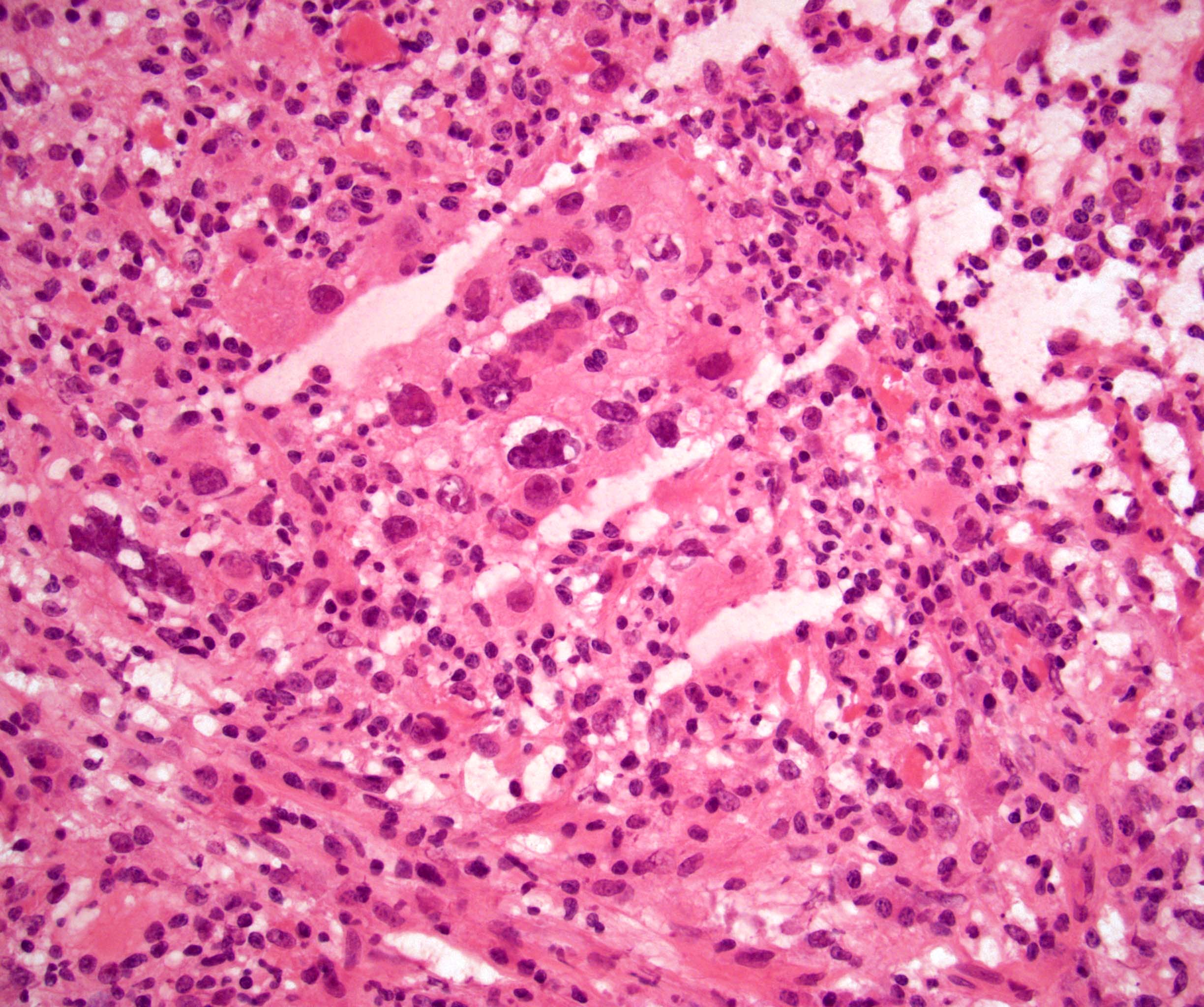 Tumor cell are difficult to identify