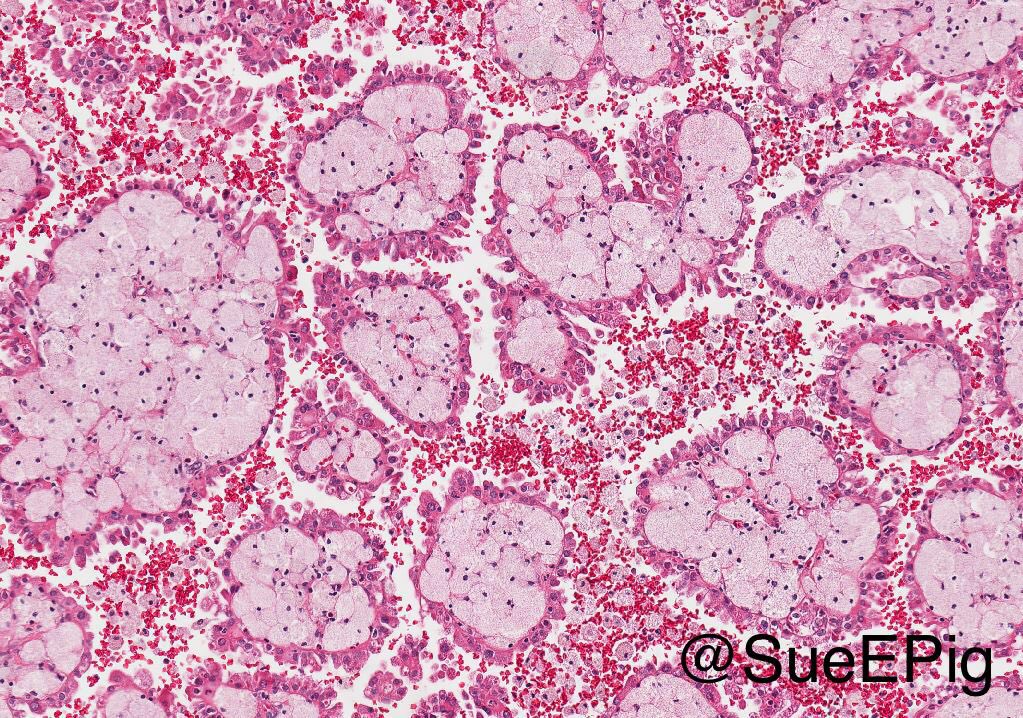 Papillary renal cell carcinoma