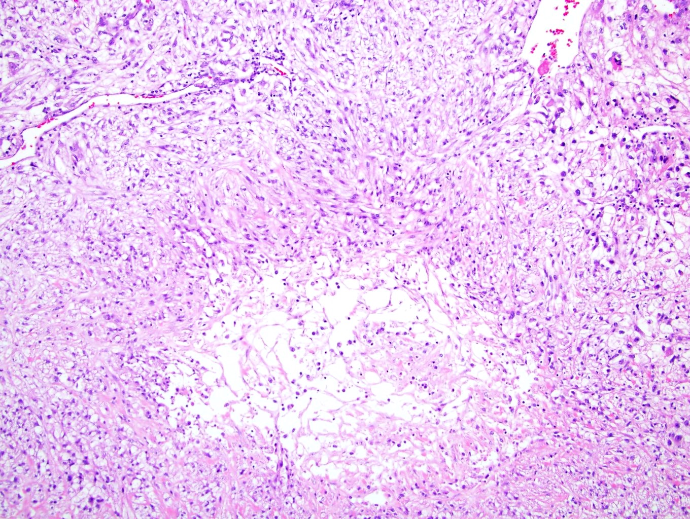 Coagulative tumor necrosis