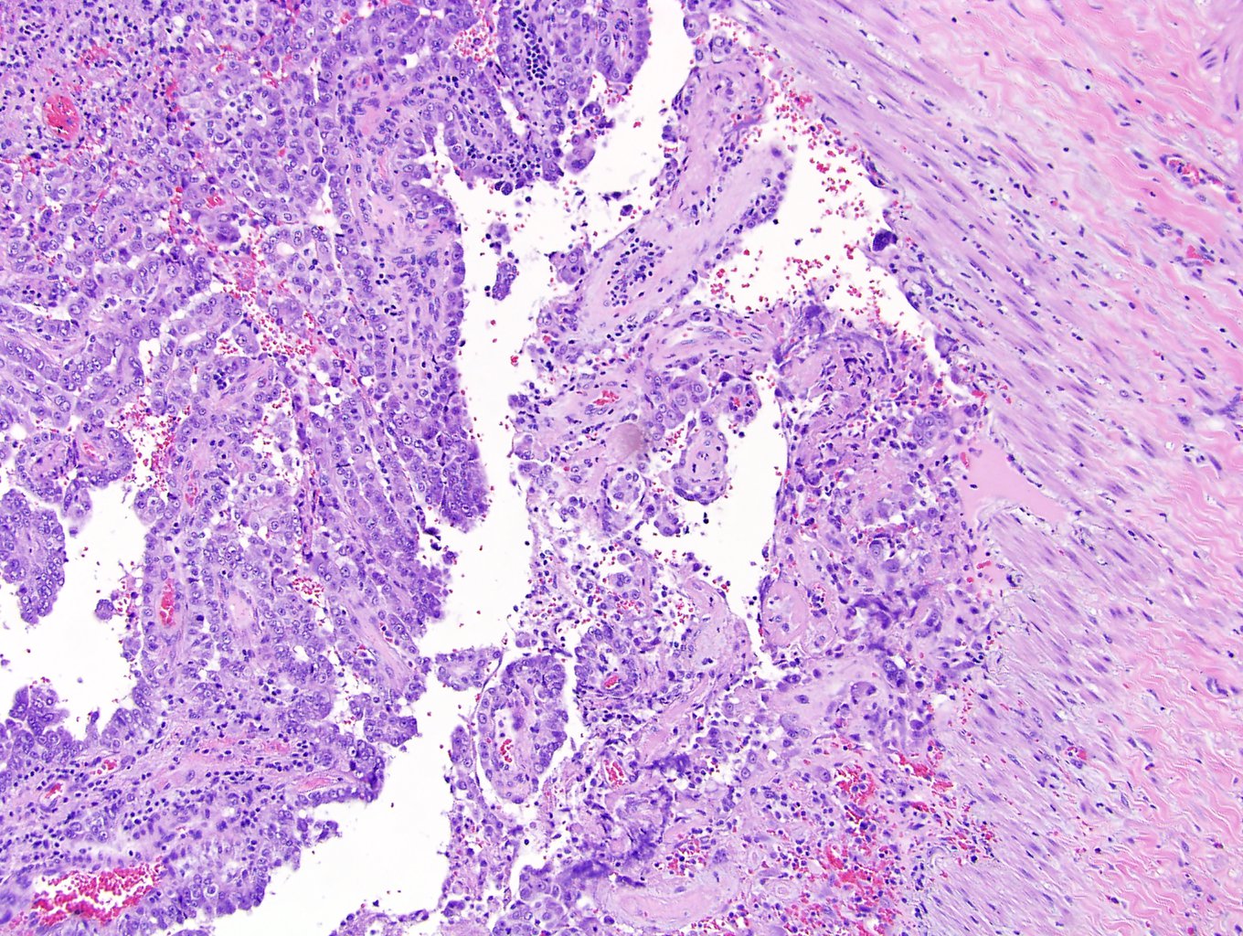 Renal cell carcinoma involving renal vein margin (pT3)